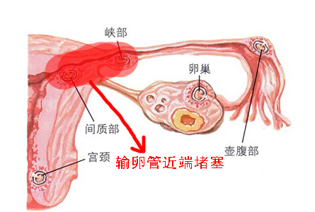 输卵管堵塞的相关知识,大多数人都不知道这个!