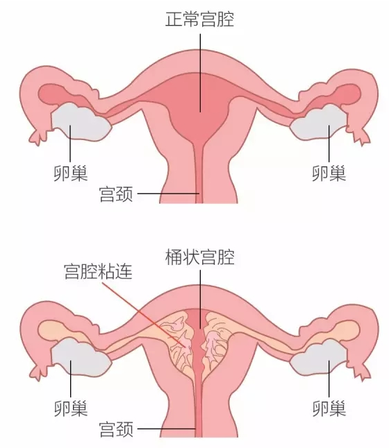 宫颈粘连.png