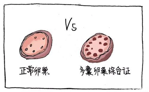 多囊.jpg